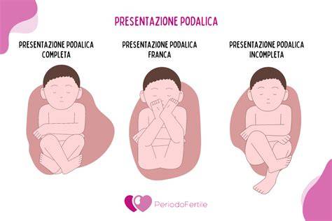 rivolgimento fetale podalico day hospital