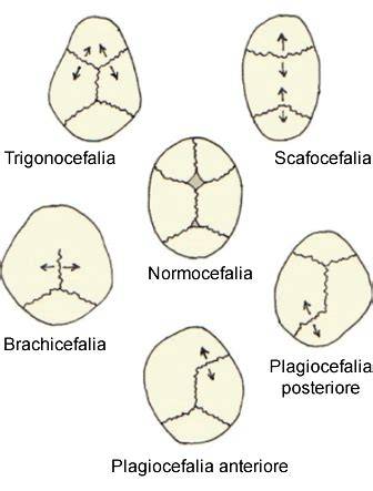 grafico sutura coronale e tipi di craniosinostosi