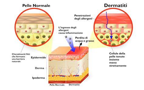 diagramma zone interessate dalla dermatite