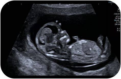 Immagine di ecografia ostetrica e placenta
