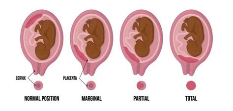 Diagramma delle posizioni placentari durante la gravidanza