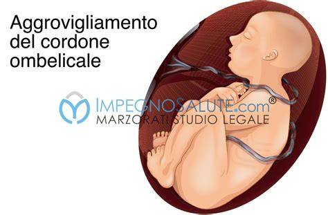 giri e nodi del cordone ombelicale