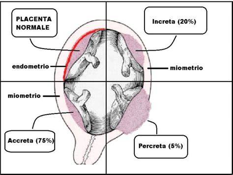 grafico percentuale residui placentari