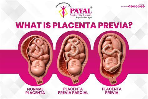diagramma localizzazione placenta previa
