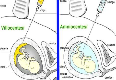 grafico confronto tempi tra villocentesi e amniocentesi