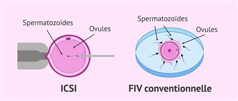 schematica FIV e ICSI