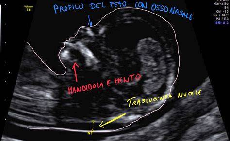 translucenza nucale e misurazione ecografica
