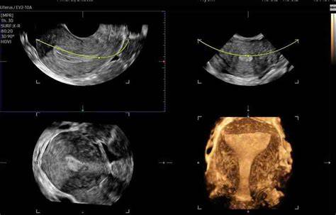 Bi-test: proteine placentari e ecografia
